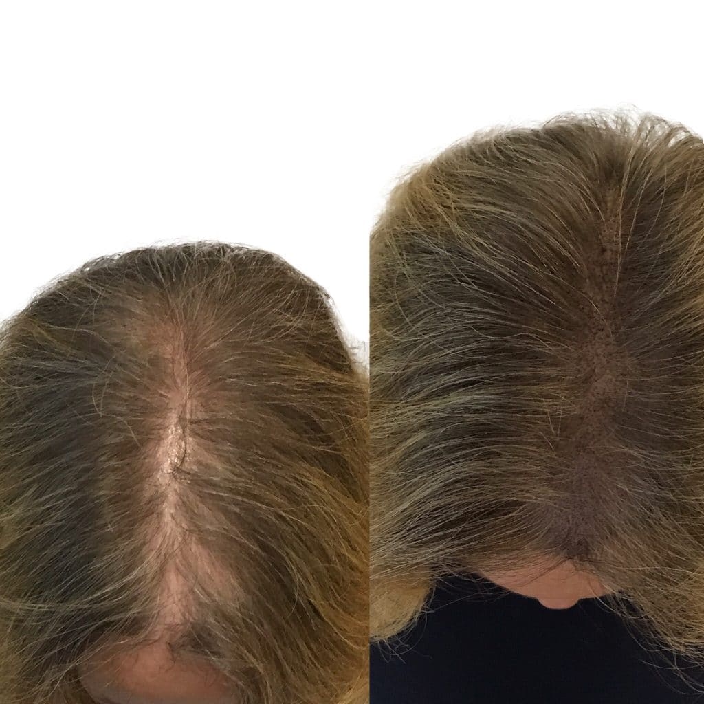before and after scalp micropigmentation for women