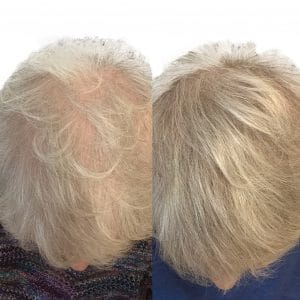 SMP density filler, grey/white hair
