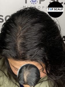 scalp micropigmentation for density, women