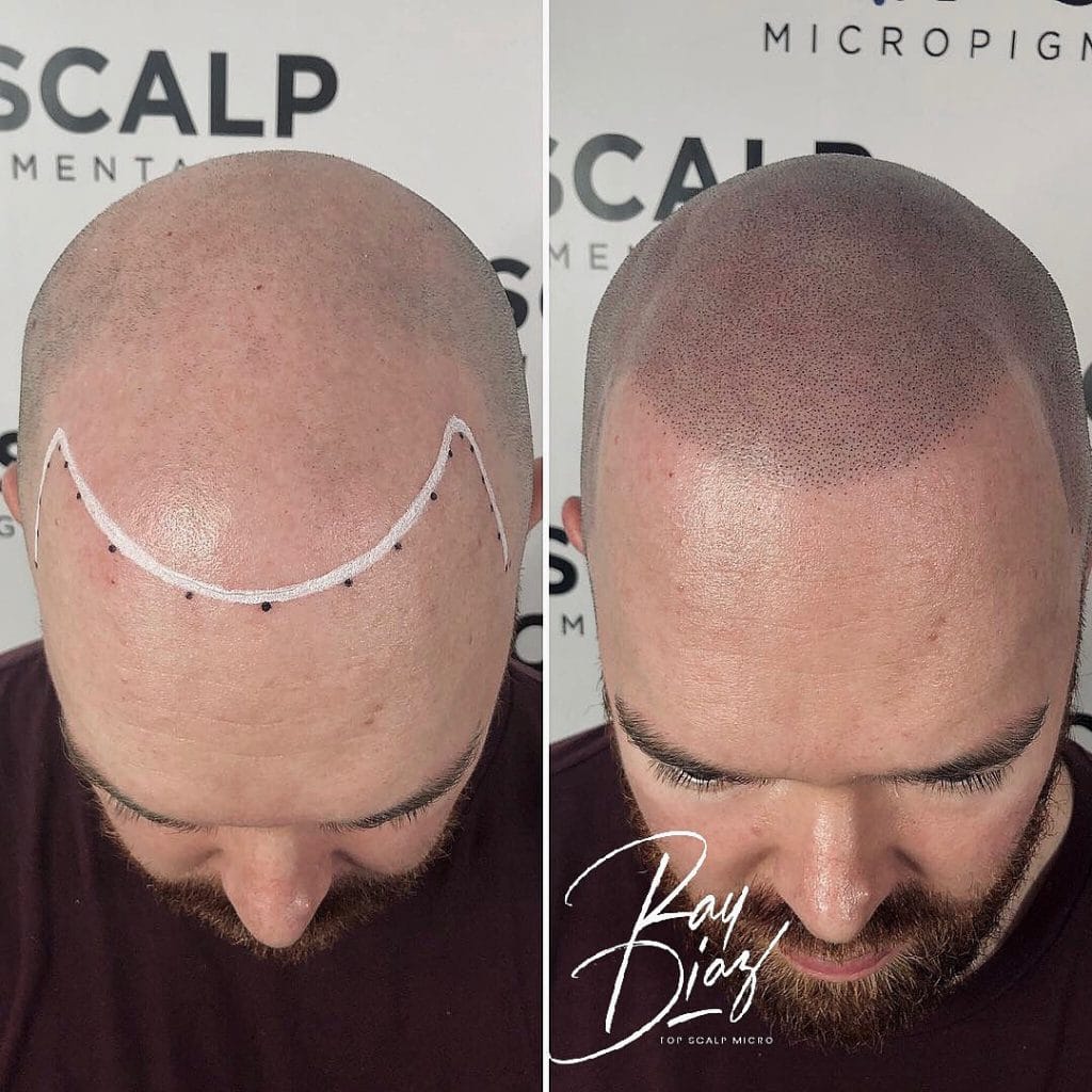 scalp micropigmentation training georgia